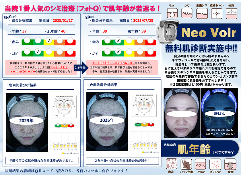 初回無料肌診断実施中！当院１番人気のシミ治療（フォトＱ）で肌年齢が若返る！
